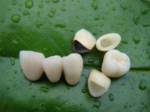 纳米烤瓷牙多少钱