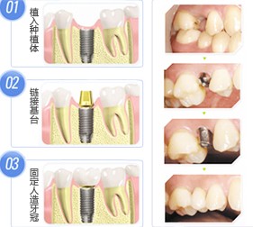 种植牙需要多长时间?