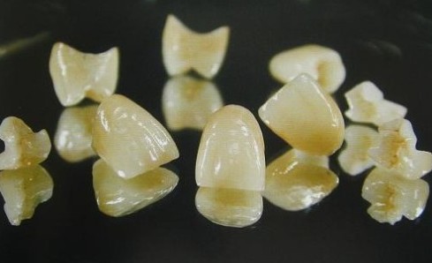 钴铬烤瓷牙套需要多少钱?