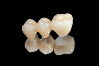 福州钴铬烤瓷牙多少钱